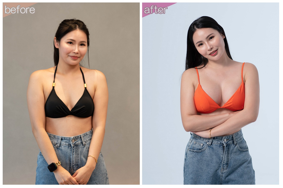 如一整形外科診所珍珠波隆乳術前術後案例