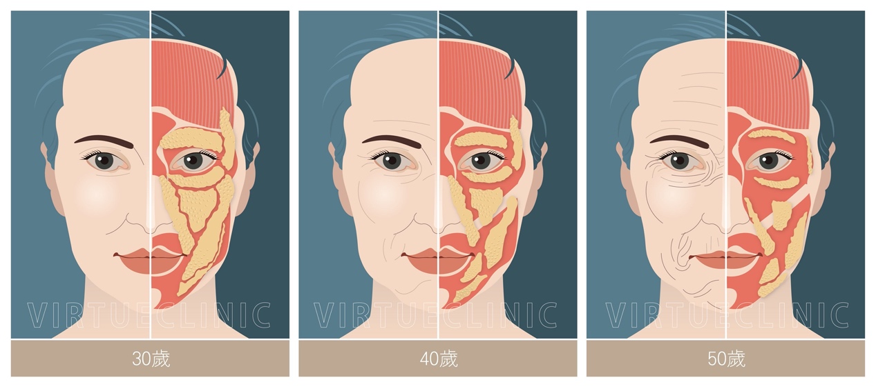 中臉部老化影響：眼袋、淚溝、蘋果肌、法令紋